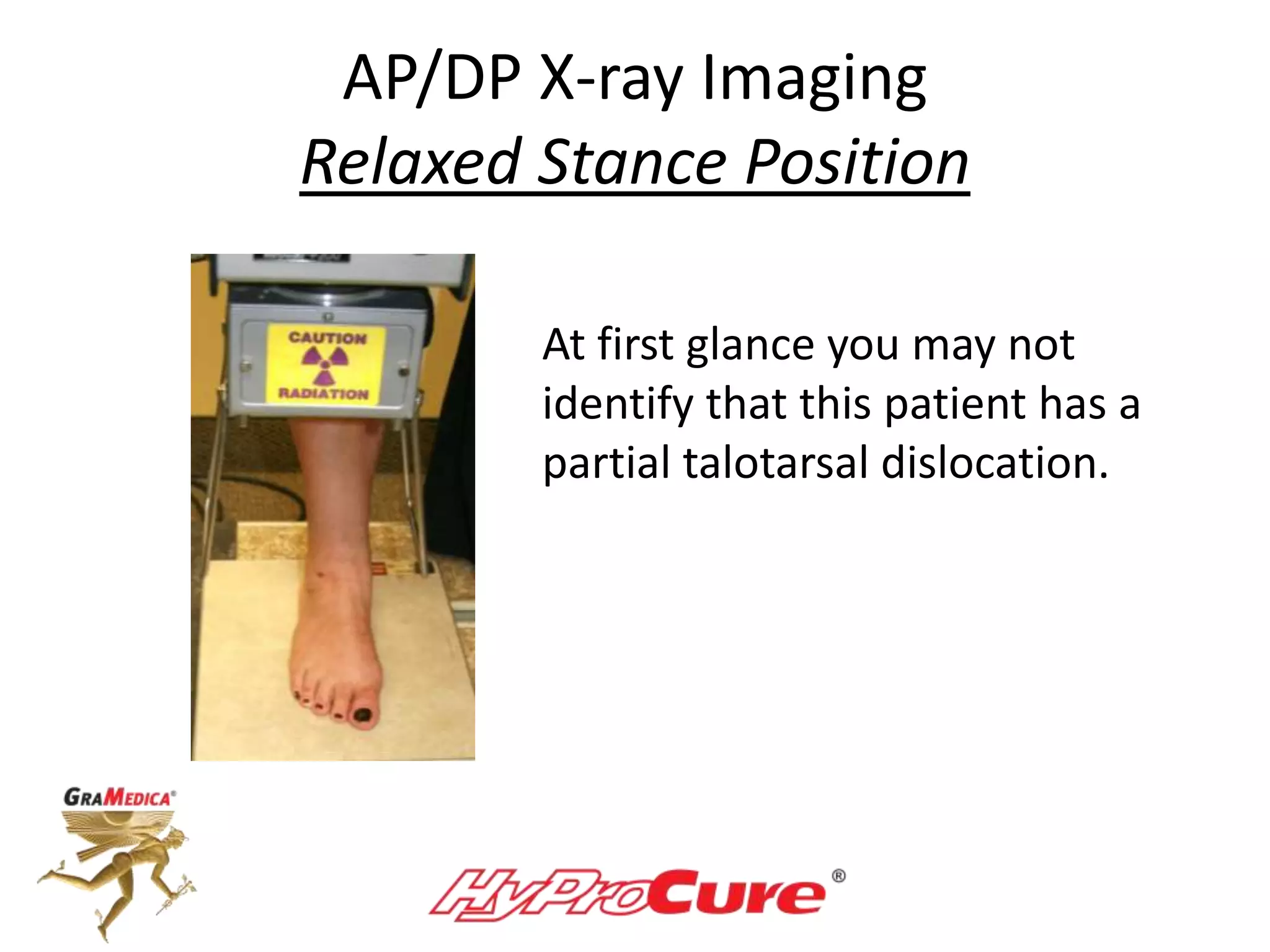 AP/DP X-ray Imaging
Relaxed Stance Position
At first glance you may not
identify that this patient has a
partial talotarsal dislocation.
 
