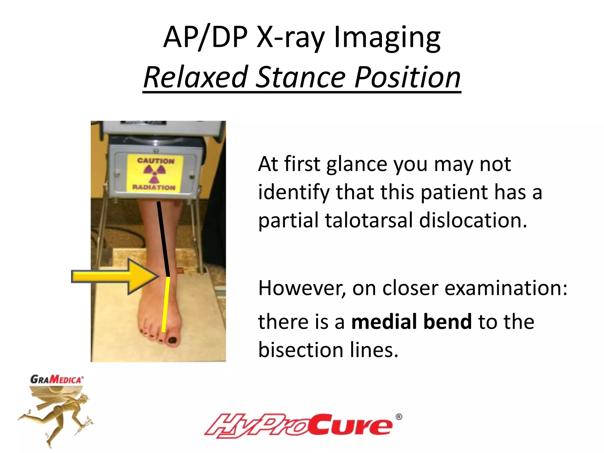 AP/DP X-ray Imaging
Relaxed Stance Position
At first glance you may not
identify that this patient has a
partial talotarsal dislocation.
However, on closer examination:
there is a medial bend to the
bisection lines.
 