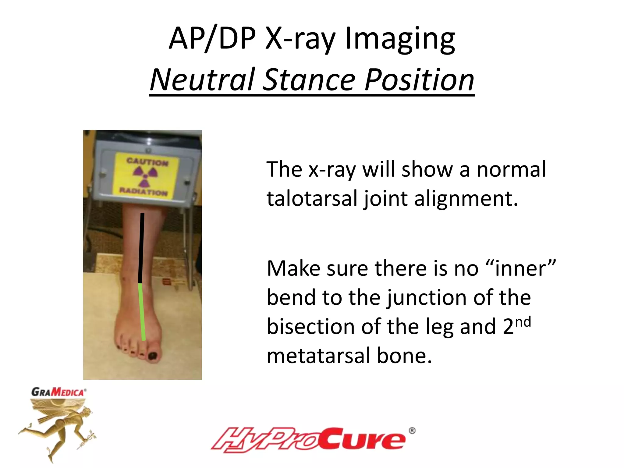 AP/DP X-ray Imaging
Neutral Stance Position
The x-ray will show a normal
talotarsal joint alignment.
Make sure there is no “inner”
bend to the junction of the
bisection of the leg and 2nd
metatarsal bone.
 