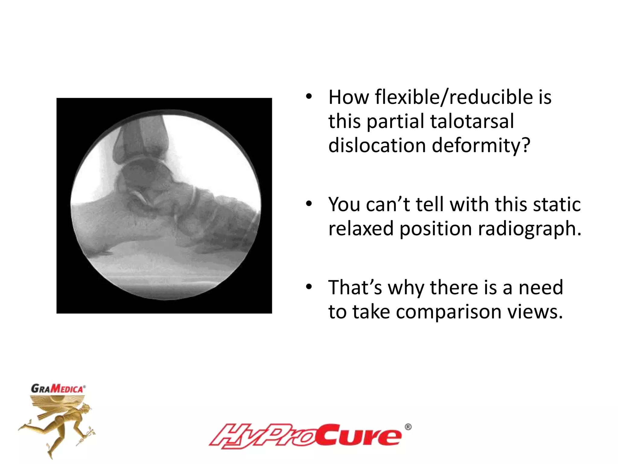 • How flexible/reducible is
this partial talotarsal
dislocation deformity?
• You can’t tell with this static
relaxed position radiograph.
• That’s why there is a need
to take comparison views.
 
