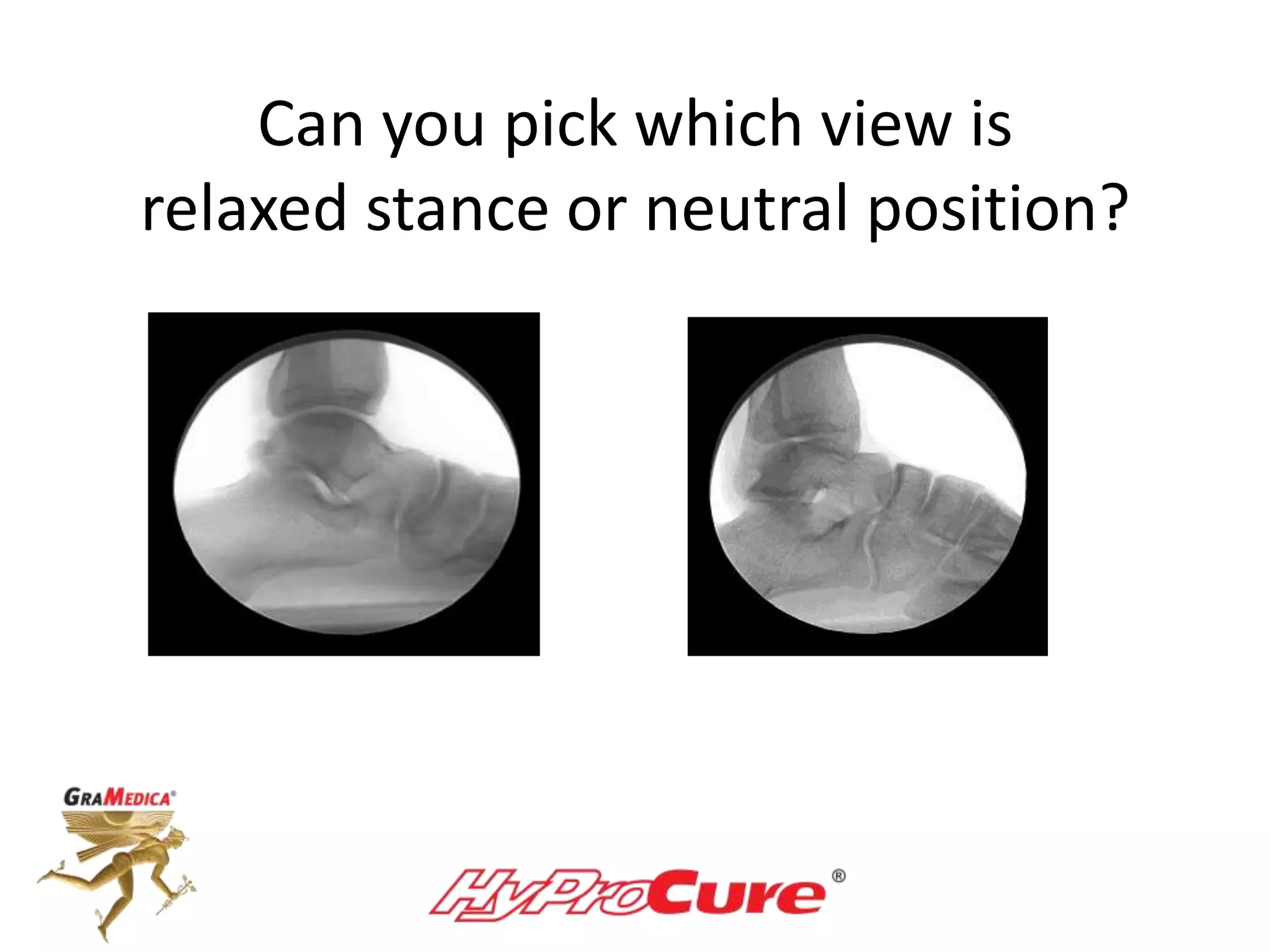 Can you pick which view is
relaxed stance or neutral position?
 