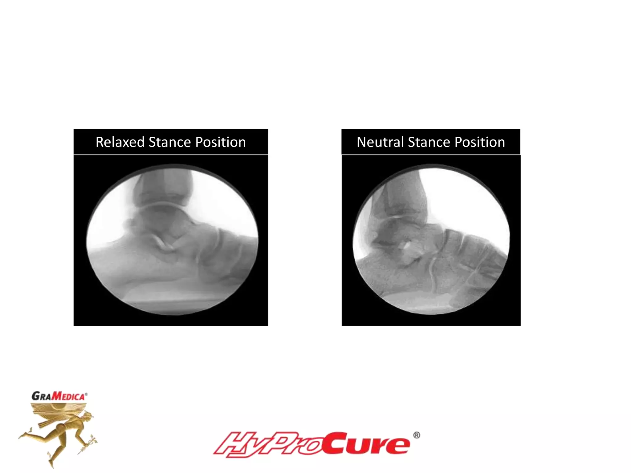 Relaxed Stance Position Neutral Stance Position
 