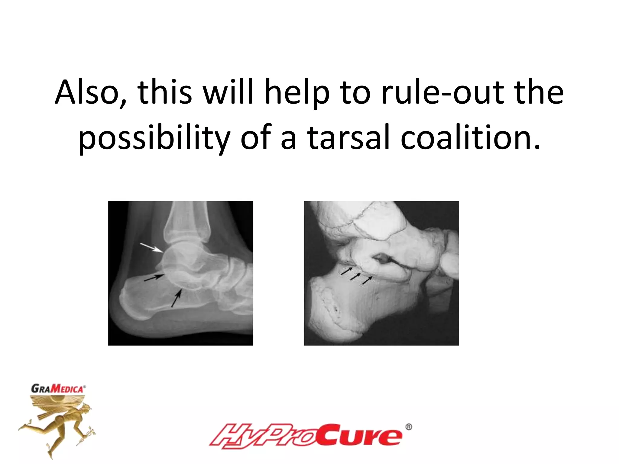 Also, this will help to rule-out the
possibility of a tarsal coalition.
 