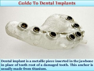 Dental implant is a metallic piece inserted in the jawbone
in place of tooth root of a damaged tooth. This anchor is
usually made from titanium.

 