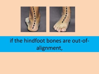 if the hindfoot bones are out-of-
            alignment,
 