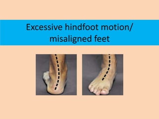 Excessive hindfoot motion/
      misaligned feet
 