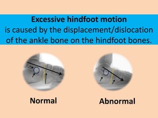 Excessive hindfoot motion
is caused by the displacement/dislocation
 of the ankle bone on the hindfoot bones.




      No...