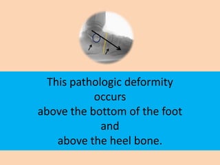 This pathologic deformity
           occurs
above the bottom of the foot
             and
    above the heel bone.
 