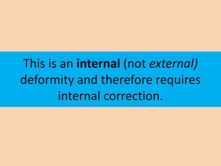 This is an internal (not external)
deformity and therefore requires
       internal correction.
 