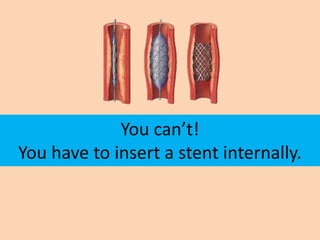 You can’t!
You have to insert a stent internally.
 