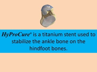 HyProCure is a titanium stent used to
           ®


   stabilize the ankle bone on the
           hindfoot bones.
 