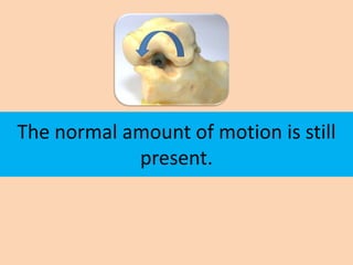 The normal amount of motion is still
            present.
 