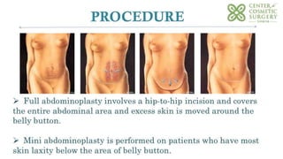 Guide to tummy tuck surgery