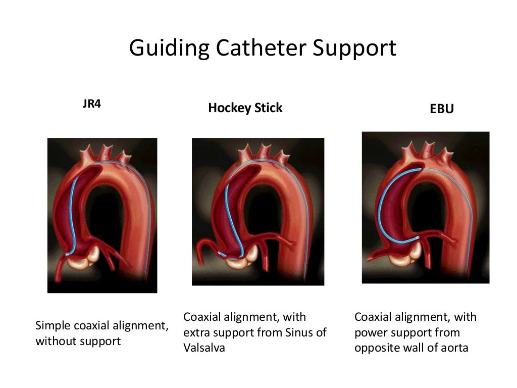 Guiding catheter in coronary intervention