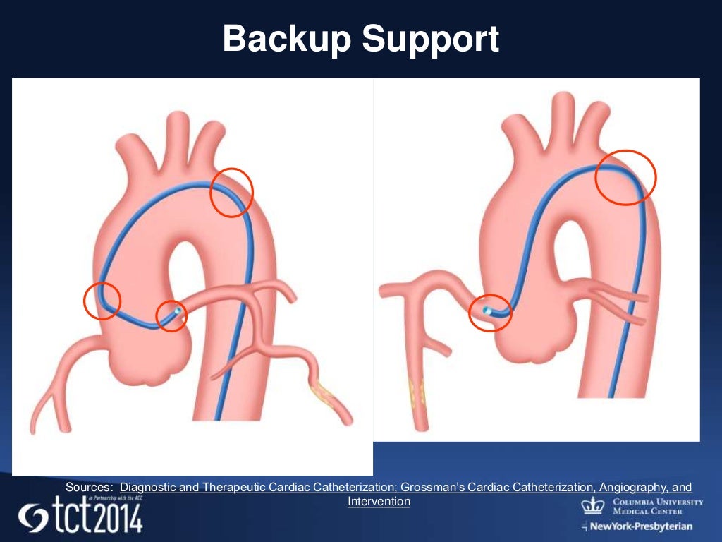 interventional cardiology, Guiding catheters, wires, and balloons e…