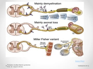 19/08/2018
Pediatric Guillain-Barré syndrome
Prof. Dr .Saad S Al Ani
12
Science Direct
 