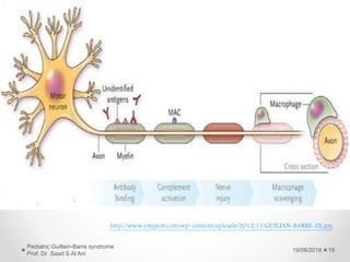 19/08/2018
Pediatric Guillain-Barré syndrome
Prof. Dr .Saad S Al Ani
19
http://www.emgtest.com/wp-content/uploads/2012/11/GUILIAN-BARRE-SX.jpg
 