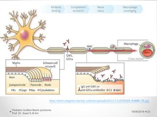 19/08/2018
Pediatric Guillain-Barré syndrome
Prof. Dr .Saad S Al Ani
23
http://www.emgtest.com/wp-content/uploads/2012/11/GUILIAN-BARRE-SX.jpg
 