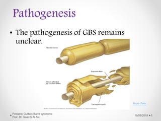 Pathogenesis
• The pathogenesis of GBS remains
unclear.
19/08/2018
Pediatric Guillain-Barré syndrome
Prof. Dr .Saad S Al Ani
5
Mayo Clinic
 