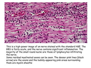 This is a high-power image of an nerve stained with the standard H&E. The
GBS is fairly acute, and the nerve contains significant inflammation. The
majority of the small round nuclei are those of lymphocytes infiltrating
the nerve.
Some residual myelinated axons can be seen. The denser pink lines (black
arrow) are the axons and the bubbly-appearing pink areas surrounding
them are myelin sheaths
 