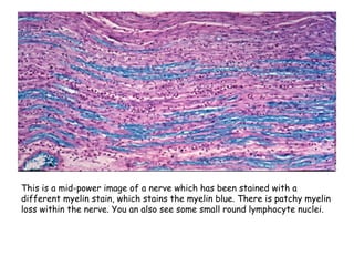 This is a mid-power image of a nerve which has been stained with a
different myelin stain, which stains the myelin blue. There is patchy myelin
loss within the nerve. You an also see some small round lymphocyte nuclei.
 