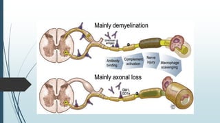Guillain barré syndrome (GBS) | PPTX