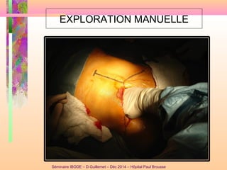 EXPLORATION MANUELLE
Séminaire IBODE – D Guillemet – Déc 2014 – Hôpital Paul Brousse
 