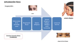 Deformidad
de la
pirámide
nasal
Respiración
Bucal
Ojeras
alérgicas
Saludo
alérgico +
pliegue
alérgico
nasal
horizontal
Líneas de
Dennie
EXPLORACIÓN FÍSICA
Inspección:
Christiaan Saavedra Alvites
ID:000062855
 