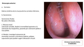 Rinoscopia anterior:
a. Cornetes:
Edema simétrico de la mucosa de los cornetes inferiores.
b. Secreciones:
Secreciones fluidas
No sobre infectadas.
c. Mucosa nasal:
coloración variable, desde la normalidad aparente a la
coloración lila inespecífica, pasando por coloración pálida o
rosa pálido.
d. Meatos: investiga la presencia de
anomalías mucosas y secretoras (edema, pólipos,
supuración) que pueden sugerir afectación sinusal.
Christiaan Saavedra Alvites
ID:000062855
 