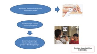 Existencia de patología
nasosinusal asociada al
proceso y d/c otras patologia
Nasofibroscopio Flexible
y endoscopios rígidos
Rinoscopia anterior con especulo y
posterior con espejo
Christiaan Saavedra Alvites
ID:000062855
 