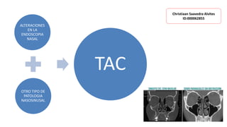 ALTERACIONES
EN LA
ENDOSCOPIA
NASAL
OTRO TIPO DE
PATOLOGIA
NASOSINUSAL
TAC
Christiaan Saavedra Alvites
ID:000062855
 