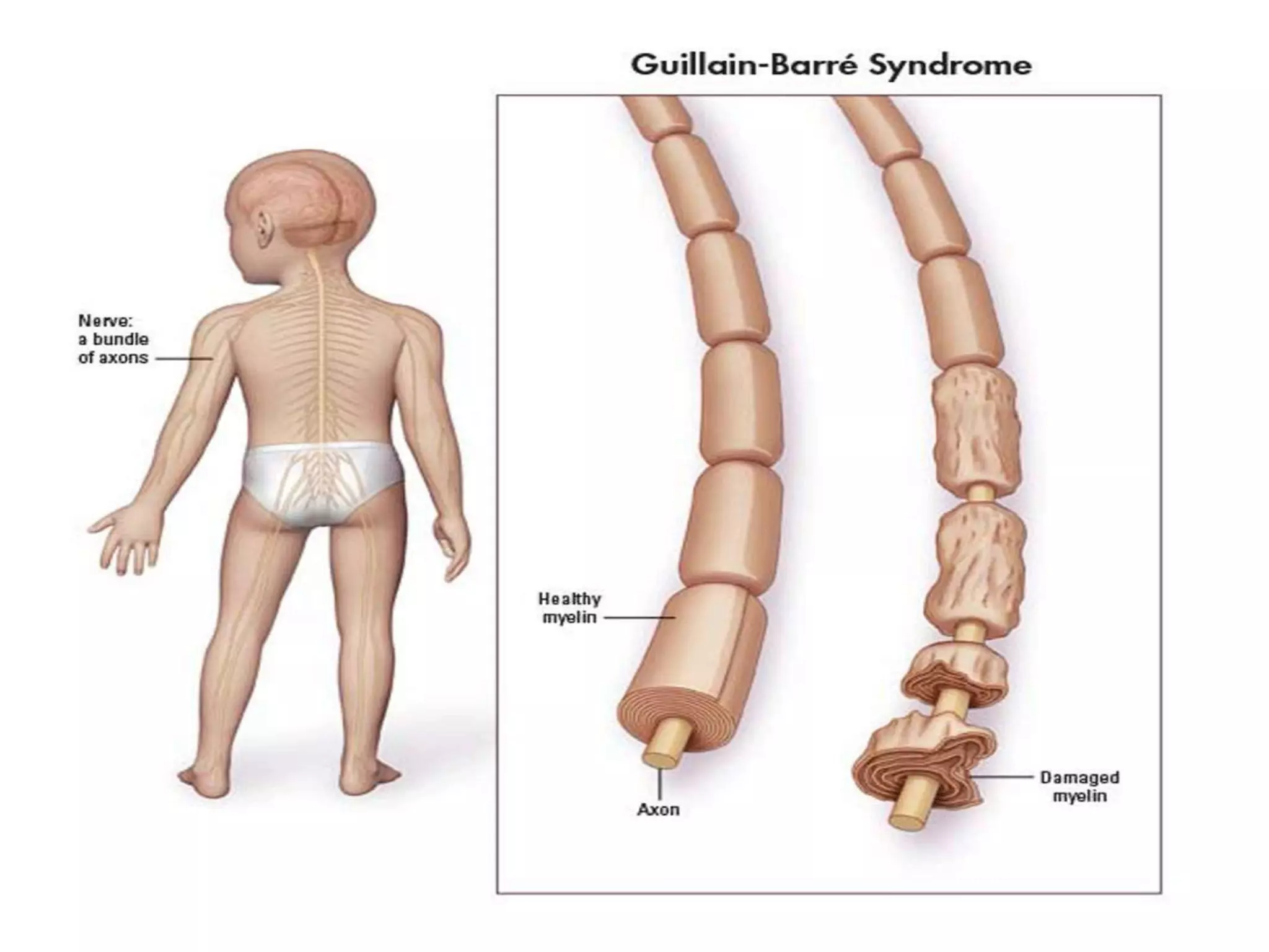 Guillen Barre Syndrome PPTX Guillen Barre Syndrome PPTX