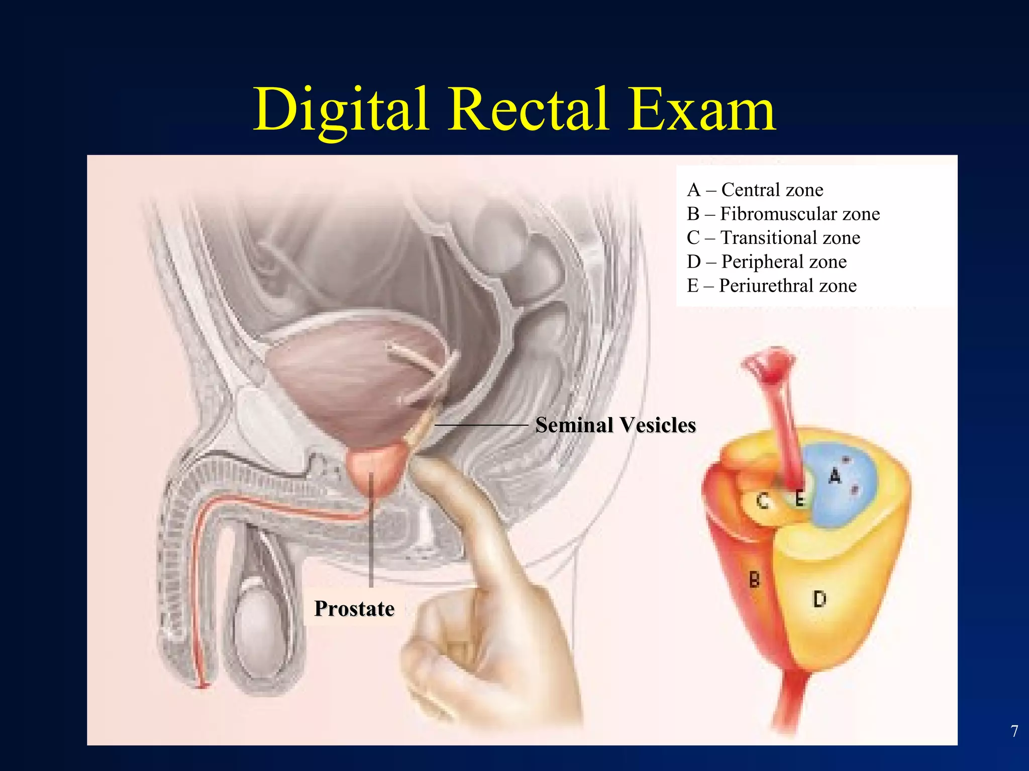 Digital Rectal Exam
                           A – Central zone
                           B – Fibromuscular zone
                           C – Transitional zone
                           D – Peripheral zone
                           E – Periurethral zone




             Seminal Vesicles




  Prostate




                                                    7
 