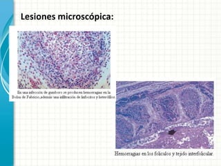 Lesiones microscópica:
 