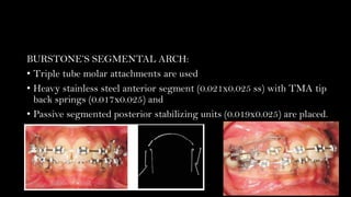Management of Gummy smile | PDF