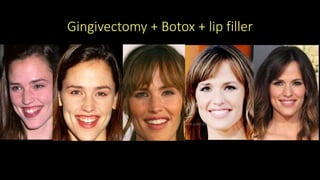 Gingivectomy + Botox + lip filler
 