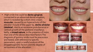 Gummy smile | PPTX
