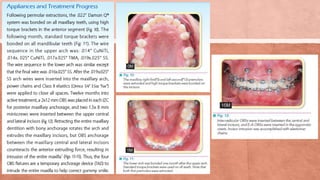 Gummy smile | PPT