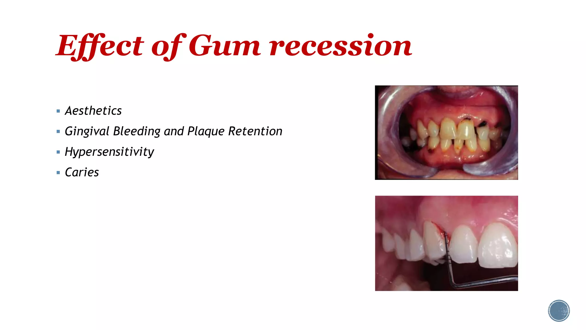 Gingival Recession | PPT