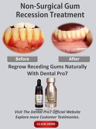 Before After
Regrow Receding Gums Naturally
With Dental Pro7
Visit The Dental Pro7 Official Website
Explore more Customer Testimonies.
 