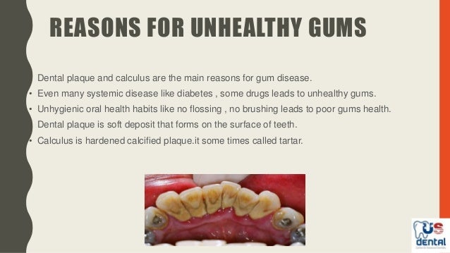 gums disease how does plaque form