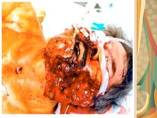 03/12/17 Dr Younas 20
Avulsive wounds
 