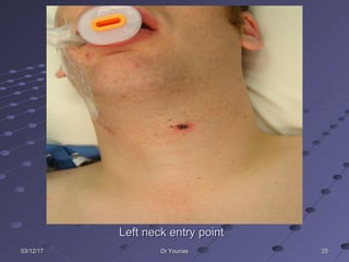 252503/12/1703/12/17 Dr YounasDr Younas
Left neck entry pointLeft neck entry point
 