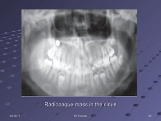 383803/12/1703/12/17 Dr YounasDr Younas
Radiopaque mass in the sinusRadiopaque mass in the sinus
 
