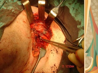 03/12/17 Dr Younas 58
Airgun pellet deep to external carotid artery
 