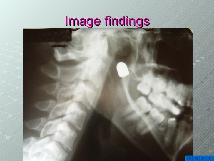 Gunshot Injury Rare Presentation