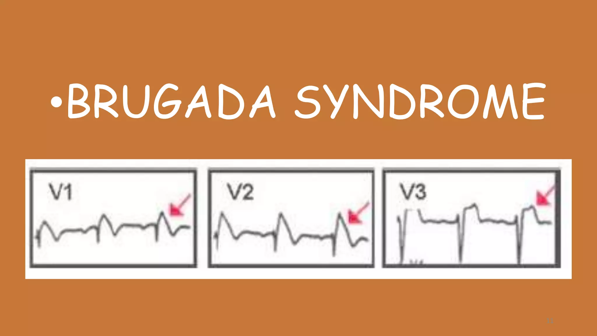 •BRUGADA SYNDROME
11
 