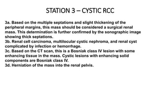 3a. Based on the multiple septations and slight thickening of the
peripheral margins, this mass should be considered a surgical renal
mass. This determination is further confirmed by the sonographic image
showing thick septations.
3b. Renal cell carcinoma, multilocular cystic nephroma, and renal cyst
complicated by infection or hemorrhage.
3c. Based on the CT scan, this is a Bosniak class IV lesion with some
enhancing tissue in the mass. Cystic lesions with enhancing solid
components are Bosniak class IV.
3d. Herniation of the mass into the renal pelvis.
STATION 3 – CYSTIC RCC
 