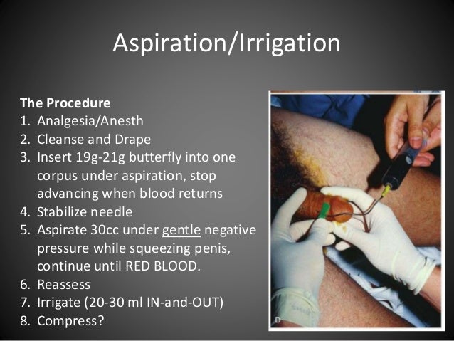 Draining Using Injection Urologic Procedures in the Emergency Department