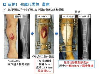 Gustilo分類type B下腿骨幹部開放骨折4例の機能成績 Gustilo分類type B下腿骨幹部開放骨折4例の機能成績